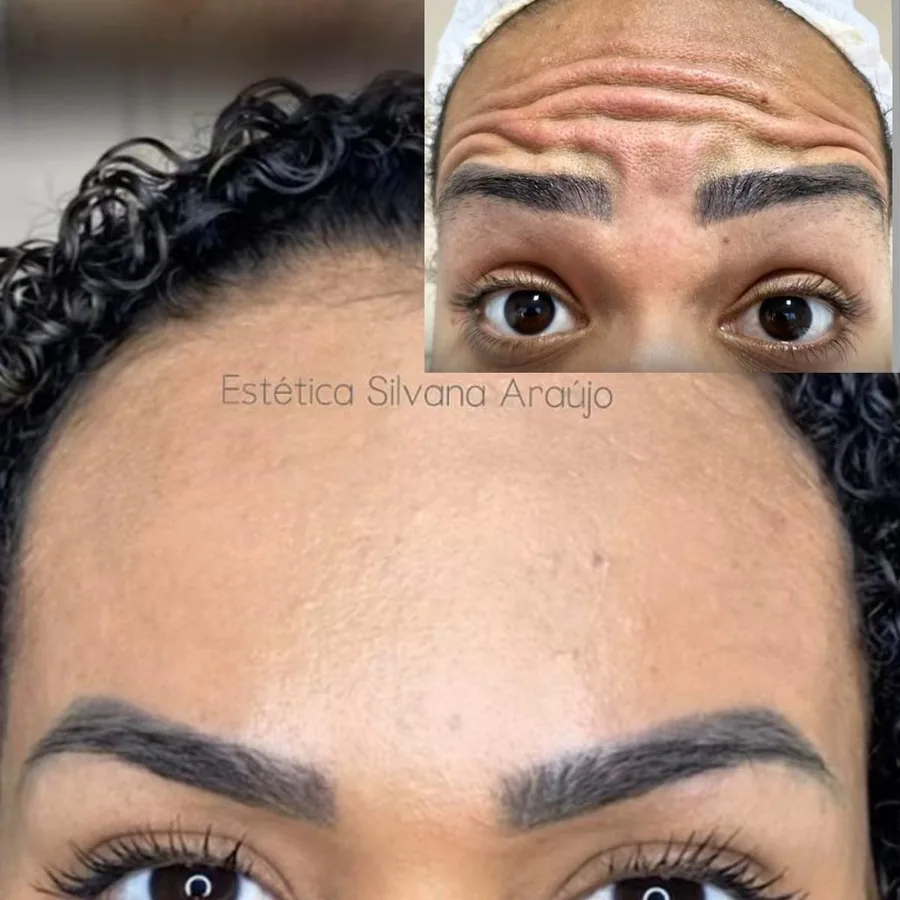 Tratamento para Linhas de Expressão em Guarulhos - Estética Silvana Araújo