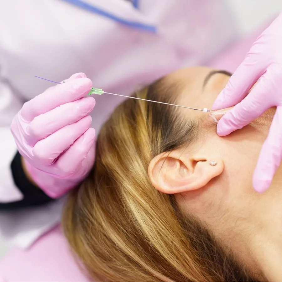 Fios de PDO em Guarulhos - Estética Silvana Araújo