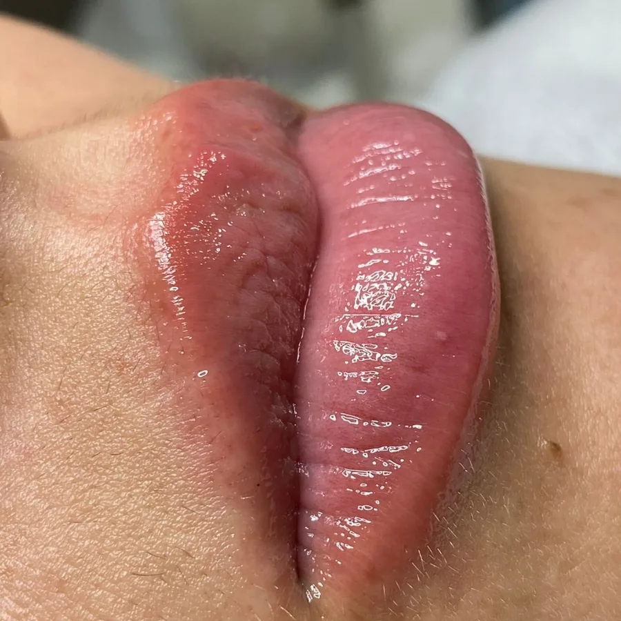 Preenchimento Labial em Guarulhos - Estética Silvana Araújo