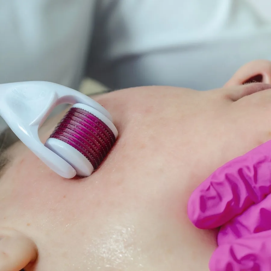 Microagulhamento em Guarulhos - Estética Silvana Araújo