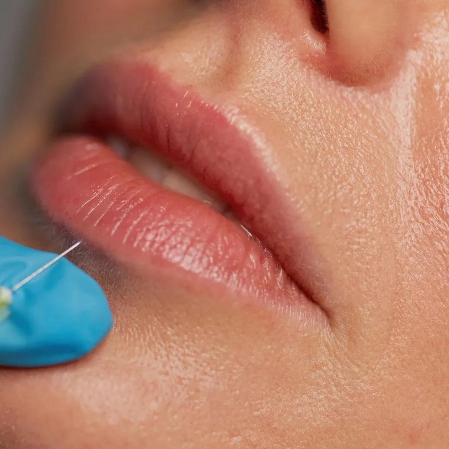 Preenchimento Labial em Guarulhos - Estética Silvana Araújo